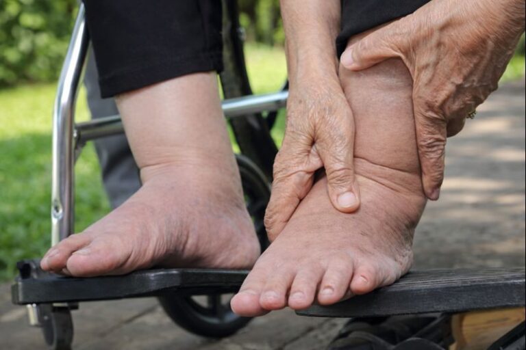 Elderly woman swollen feet press test on wheelchair