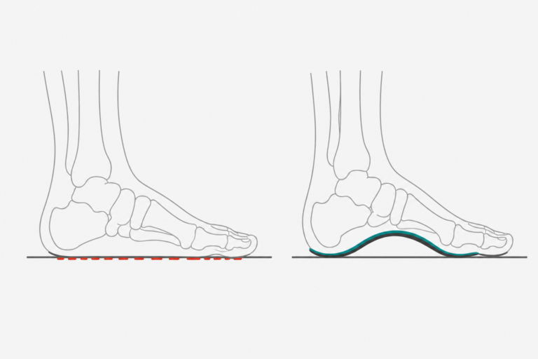 Side-by-side illustration of a flat foot skeleton and a foot supported by an arch support insole, showing how orthotic support changes arch position and foot alignment.